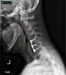 Animated image of the spine after a spinal fusion