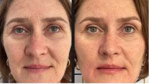 Facial Reposturing: Best Anti-Aging Skin Treatment for Women