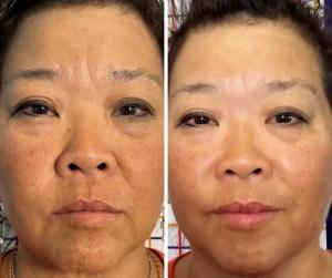 Anti-Wrinkle Skin Treatment for Aging Facial Skin