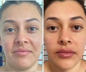 Facial Reposturing Face and Skin Treatment in San Mateo, CA