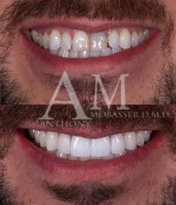 Smile-Makeover-with-3-Veneers-and-One-Crown-in-Los-Angeles