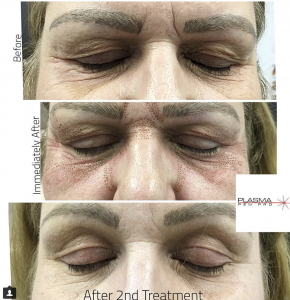 Plamere Plasma Pen Pro (PPP) Eyelid and Eyebrow Lift Before and After