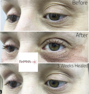 Plasma Pen Eyelid Lift Training by Plasma Pen Pro