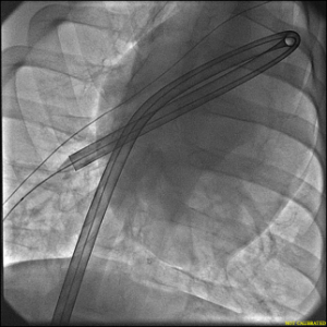 A photograph depicting the DogLeg 24F Aspiration Catheter navigating smoothly through a challenging angle in a porcine model, demonstrating its flexibility and effectiveness without kinking.