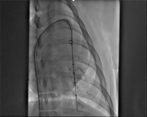 Fluoroscopic view of the ClotHound ACE Gold PE mechanical thrombectomy catheter device advancing through the DogLeg 24F catheter into the distal pulmonary artery, demonstrating precise navigation for treating pulmonary embolism.