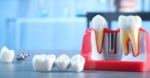 Single Tooth Implants and Dental Bridges (2)