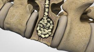 Image shows OsteoPearl implanted in a bone with osteoporosis.