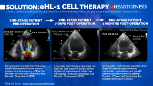 EVIDENCED-BASED CELL THERAPY CLINICAL TRANSLATION RESULTS FOR NO-OPTION, HIGH-RISK, ADVANCED-STAGE or END-STAGE HEART FAILURE PATIENTS
