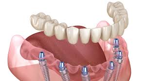 Dental Implants And Prosthesis Market