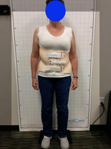  Scoliosis Bracing at Square One Health