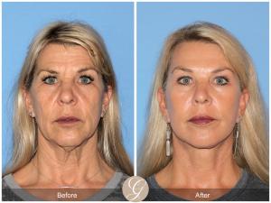 Women in her early 60's that had a Preservation Face Lift with Dr. Kevin Sadati