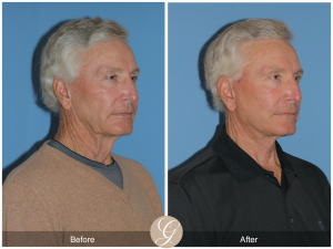 Facelift For man in his 70's