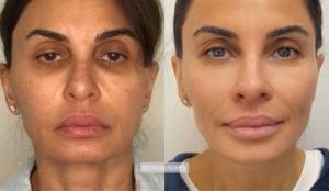 efore and after images showcasing the results of Dr. Simon Ourian's non-surgical facelift, highlighting significant improvements in skin texture and facial symmetry.