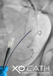 2.0F XO Cath Microcatheter Performs Impressively in First Case, a Prostatic Artery Embolization