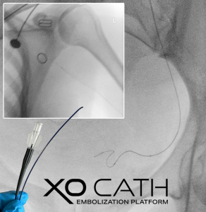 XO Cath Microcatheter used without a support catheter in radial UAE case