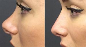 Side-by-side comparison of a patient's nose before and after a non-invasive rhinoplasty treatment by Dr. Simon Ourian, showing a smoother and more refined nasal profile.