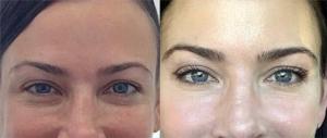 comparison showing the same woman before and after a dark circle removal treatment. The 'before' image on the left highlights prominent dark circles under the eyes, while the 'after' image on the right displays significantly brighter and smoother skin around the eyes