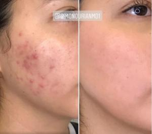 Before and after image showing the transformation of a woman's cheek, with severe acne and scarring on the left side and clear, smooth skin after treatment on the right.