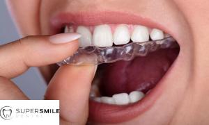 invislign teeth aligners