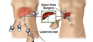 laparoscopic and open surgery