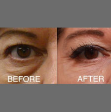 Comparison image showing the before and after results of a dark circle removal treatment. The 'before' side displays noticeable under-eye circles, while the 'after' side reveals a smoother, brighter under-eye area.