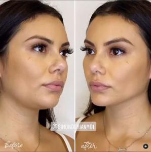 Side-by-side comparison showing a woman before and after receiving a non-invasive jawline contouring treatment by Dr. Simon Ourian, highlighting a more defined and sculpted jawline.