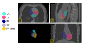 AutoChamber AI segmentation showing heart chambers and left ventricular wall