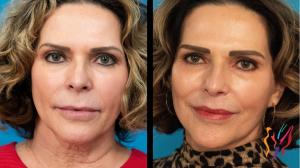 Before and after photo of a patient at Advanced Cosmetic Surgery & Laser center after receiving an Advanced Facelift, Upper Blepharoplasty, Subnasal Lip Lift and DOT Laser facial resurfacing treatment