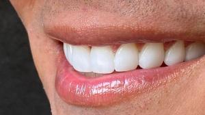 Veneers in Colombia