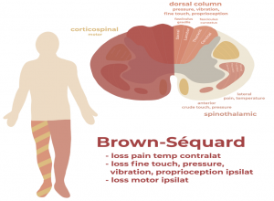 Brown-Sequard