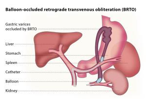 Kidney Balloon