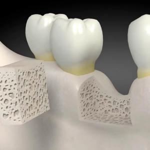 Dental Bone Graft Substitute