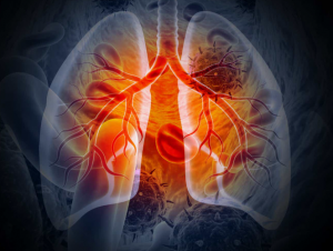 Global Lung Cancer Therapeutics