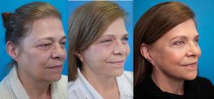 A facelift patient of Dr. Jon Mendelsohn during pre-op, 1 week post-op and 8 weeks post-op