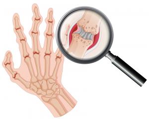 Rheumatoid Arthritis Therapeutics Business