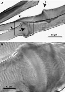 Potential Trigger Point Foci (acute sites of contractility within a muscle) - https://brookbushinstitute.com/glossary/trigger-point