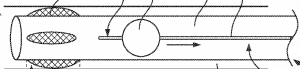 Image of an aspiration catheter with cushions at the distal end, designed to center within the vessel. The cushions are shown reverted.