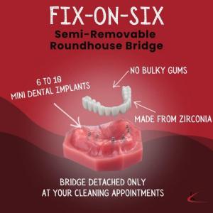 Snap-On Dentures in Winston-Salem, NC - All-on-4 Alternatives