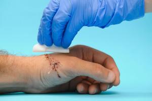 Nurse cleaning a hand wound with a sterile dressing set