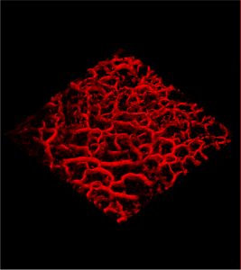 VivoSight OCT 3D image of blood vessels in a Port Wine Birthmark, in area of skin 6 mm x 6 mm