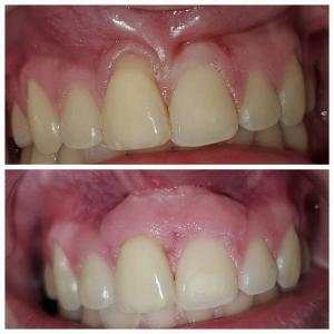 Gum Grafting