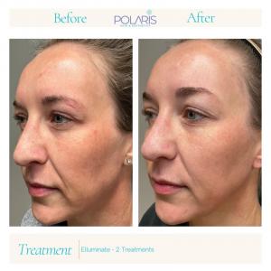 Brighter, clearer, more radiant skin after just two Elluminate treatments. This multi-modal laser therapy targets uneven tone, redness, and textural irregularities—revealing a smoother, healthier-looking complexion with minimal downtime.