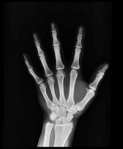 Hypophosphatasia Market Forecast