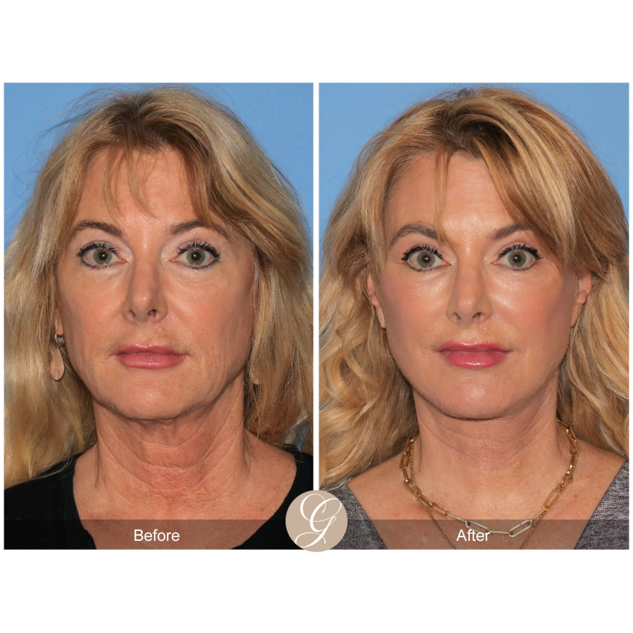 Dr Kevin Sadati Has Been Recognized As One Of The Top Facelift Surgeons In California By The