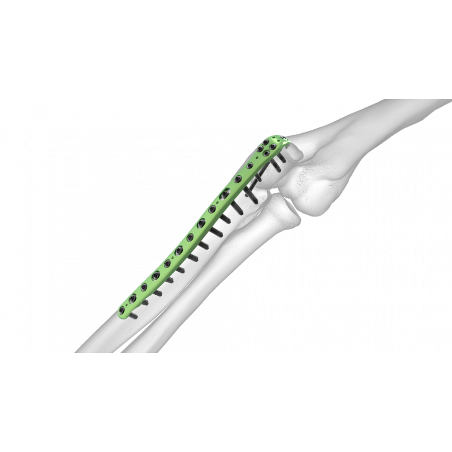 Elbow Plating System Market constantly growing to See Bigger Picture ...